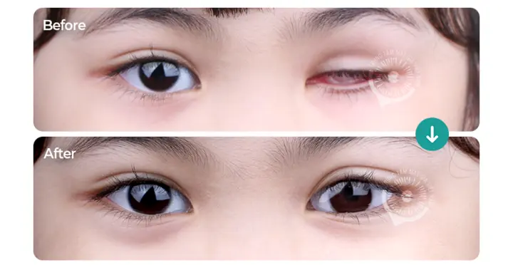 Hợp tác vì một cuộc sống trọn vẹn hơn cho người khiếm khuyết nhãn cầu