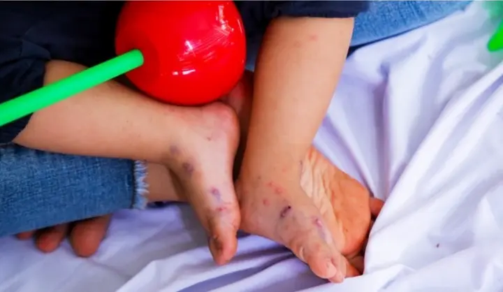 Việt Nam lần đầu triển khai tiêm vắc xin phòng bệnh tay chân miệng