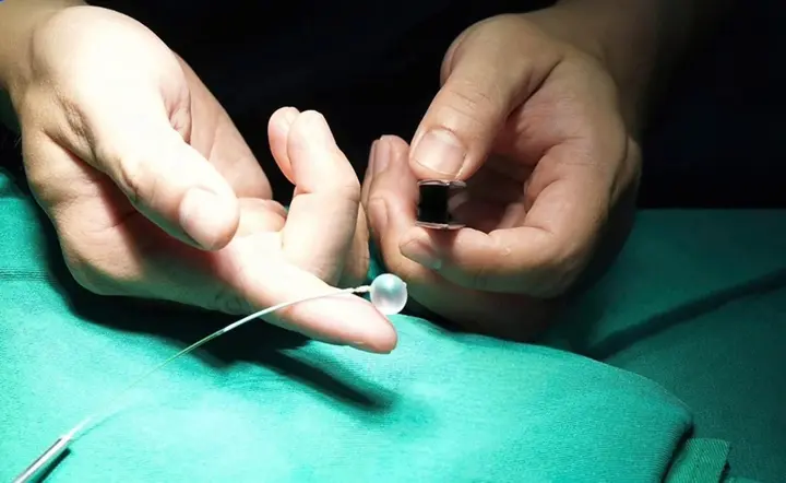 Lần đầu tại Việt Nam: Đặt bóng vào khí quản cứu thai nhi mắc thoát vị hoành