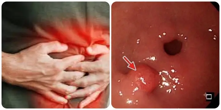 7 dấu hiệu ung thư dạ dày không nên bỏ qua