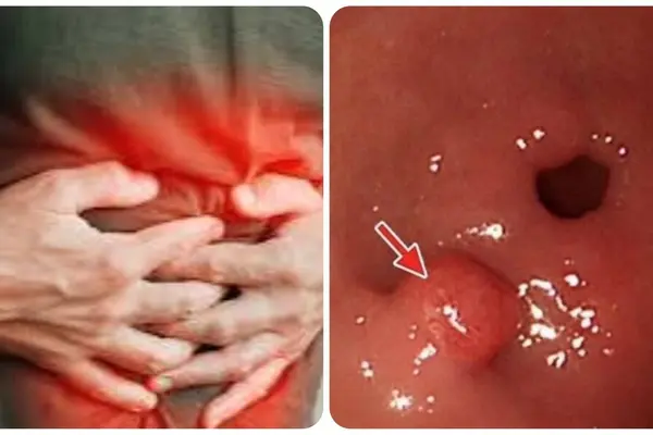 7 dấu hiệu ung thư dạ dày không nên bỏ qua