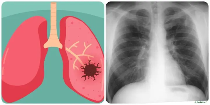 9 dấu hiệu ung thư phổi giai đoạn đầu