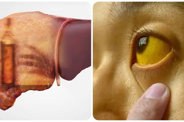 4 dấu hiệu ung thư gan giai đoạn cuối
