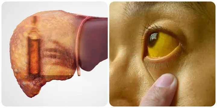 4 dấu hiệu ung thư gan giai đoạn cuối