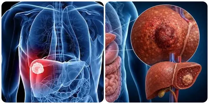 9 triệu chứng ung thư gan giai đoạn đầu